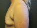 Breast Augmentation Patient 18 Before - 2 Thumbnail