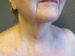 Facelift Patient 09 Before - 4 Thumbnail