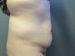 Tummy Tuck Patient 07 Before - 4 Thumbnail