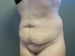 Tummy Tuck Patient 07 Before - 3 Thumbnail