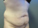 Tummy Tuck Patient 07 Before - 2 Thumbnail