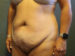 Tummy Tuck Patient 08 Before - 4 Thumbnail