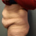 Tummy Tuck Patient 09 Before - 2 Thumbnail