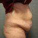 Tummy Tuck Patient 09 Before - 3 Thumbnail