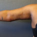 Arm Lift Patient 07 After Thumbnail