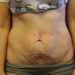 Tummy Tuck Patient 10 Before Thumbnail