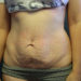 Tummy Tuck Patient 10 Before - 3 Thumbnail