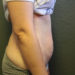 Tummy Tuck Patient 10 Before - 4 Thumbnail