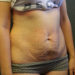 Tummy Tuck Patient 10 Before - 5 Thumbnail