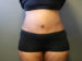 Tummy Tuck Patient 11 After Thumbnail