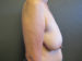 Breast Reduction Patient 14 Before - 3 Thumbnail