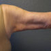 Arm Lift Patient 08 After - 2 Thumbnail