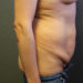 Tummy Tuck Patient 12 Before - 2 Thumbnail