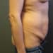 Tummy Tuck Patient 12 Before - 2 Thumbnail