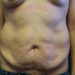 Tummy Tuck Patient 12 Before Thumbnail