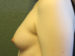 Breast Augmentation Patient 22 Before - 5 Thumbnail