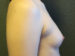 Breast Augmentation Patient 22 Before - 3 Thumbnail