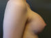 Breast Augmentation Patient 22 After - 3 Thumbnail