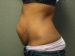 Tummy Tuck Patient 13 Before - 2 Thumbnail