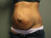 Tummy Tuck Patient 13 Before - 3 Thumbnail