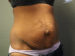 Tummy Tuck Patient 13 Before - 5 Thumbnail