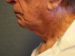 Facelift Patient 11 Before - 4 Thumbnail