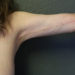 Arm Lift Patient 09 After - 2 Thumbnail