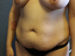 Tummy Tuck Patient 14 Before - 3 Thumbnail