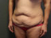 Tummy Tuck Patient 15 Before - 2 Thumbnail