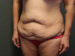 Tummy Tuck Patient 15 Before - 2 Thumbnail