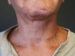 Facelift Patient 12 After - 2 Thumbnail