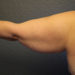 Arm Lift Patient 10 Before - 2 Thumbnail