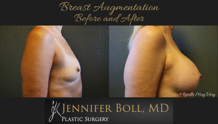 Before and after image showing the results of a breast augmentation performed in Tempe, AZ.