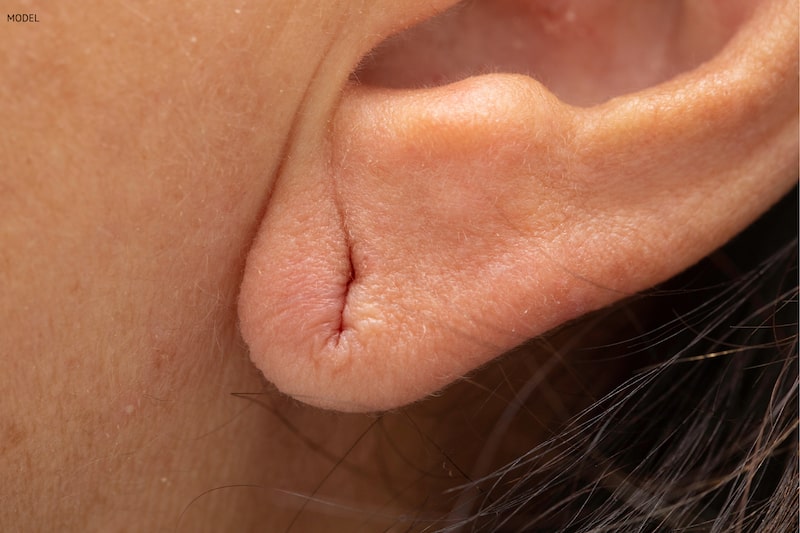 Close-up of earlobe with a torn piercing.