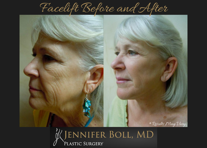 Before and after image showing the results of a facelift performed in Tempe, AZ.