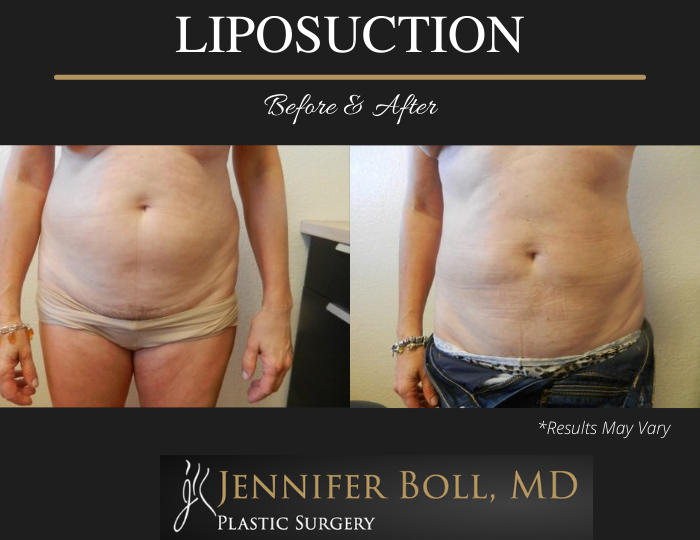 Before and after results showing the results of a liposuction treatment performed in Tempe, AZ.