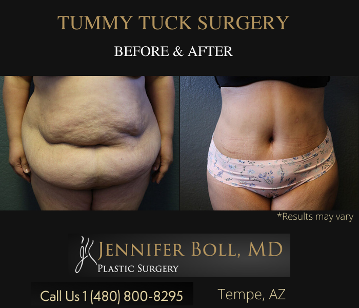 Before and after image showing the results of a tummy tuck performed in Tempe, AZ.