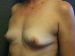 Breast Augmentation Patient 23 Before - 4 Thumbnail