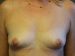 Breast Augmentation Patient 23 Before Thumbnail