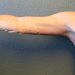 Arm Lift Patient 11 After Thumbnail