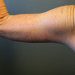 Arm Lift Patient 11 After - 3 Thumbnail
