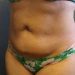 Tummy Tuck Patient 17 Before - 2 Thumbnail