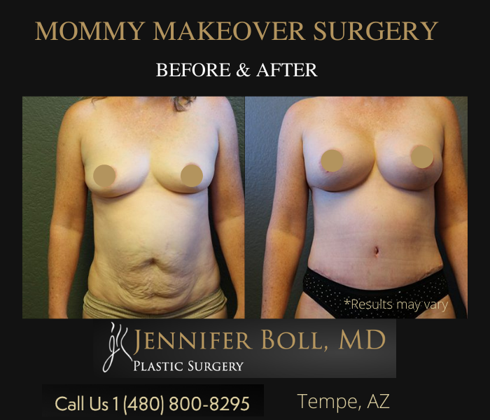 before and after of Mommy Makeover - before has loose skin on tummy - after shows a flat tummy and bigger breasts.