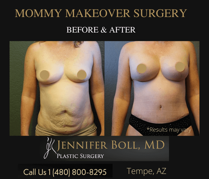 before and after of Mommy Makeover - before has loose skin on tummy - after shows a flat tummy and bigger breasts.