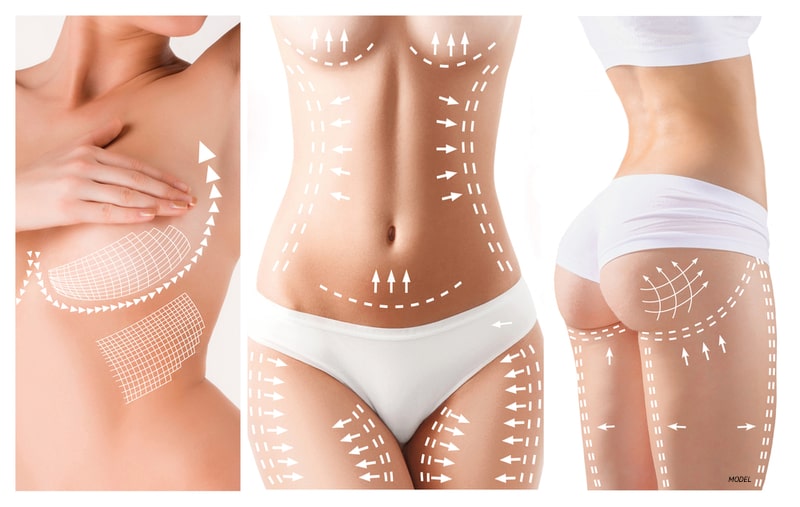 Three pictures of a women's body: breast, abs, and butt with arrows illustrating the direction of lift that is desired during cosmetic surgeries.