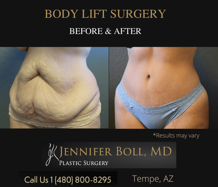 Before and after image showing the results of a body lift performed in Tempe, AZ.