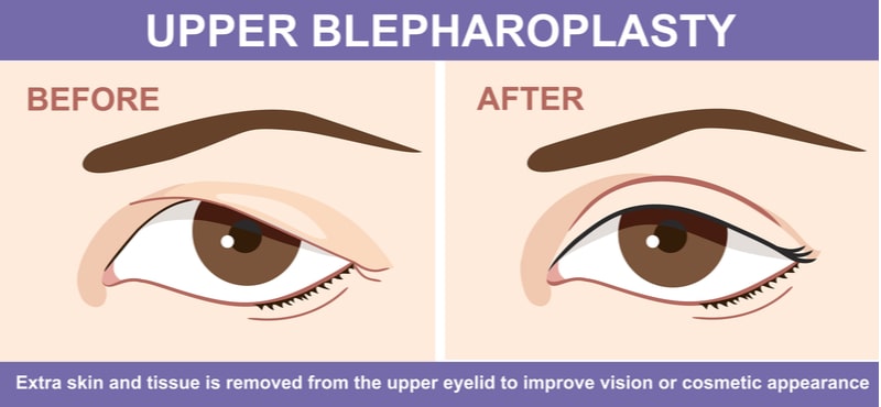 Illustration before and after image showing blepharoplasty (eyelid surgery).