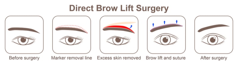 Illustration showing how a brow lift is performed.