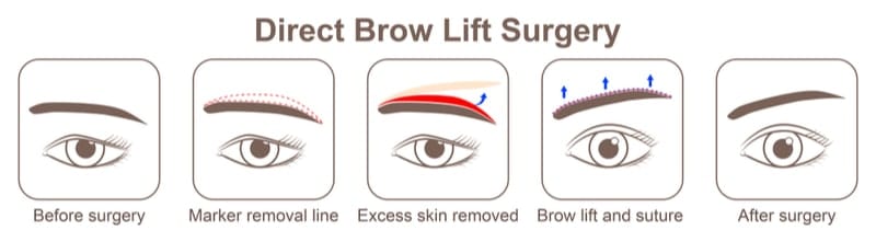 Illustration showing how a brow lift is performed.