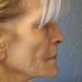 Facelift Patient 14 Before - 3 Thumbnail